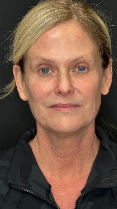 ContourLift Before & After Gallery - Patient 838284 - Image 1