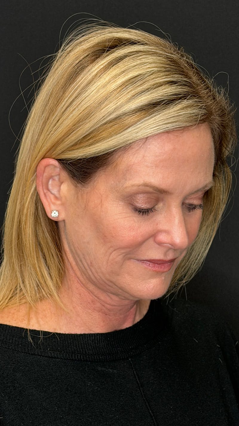 Deep Plane Facelift 50s Before & After Gallery - Patient 334108 - Image 11
