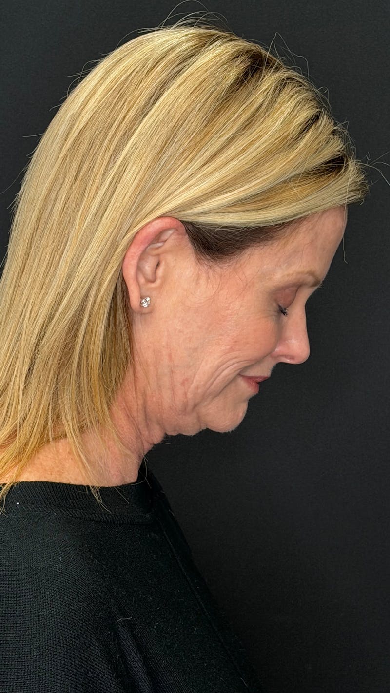 Deep Plane Facelift 50s Before & After Gallery - Patient 334108 - Image 9