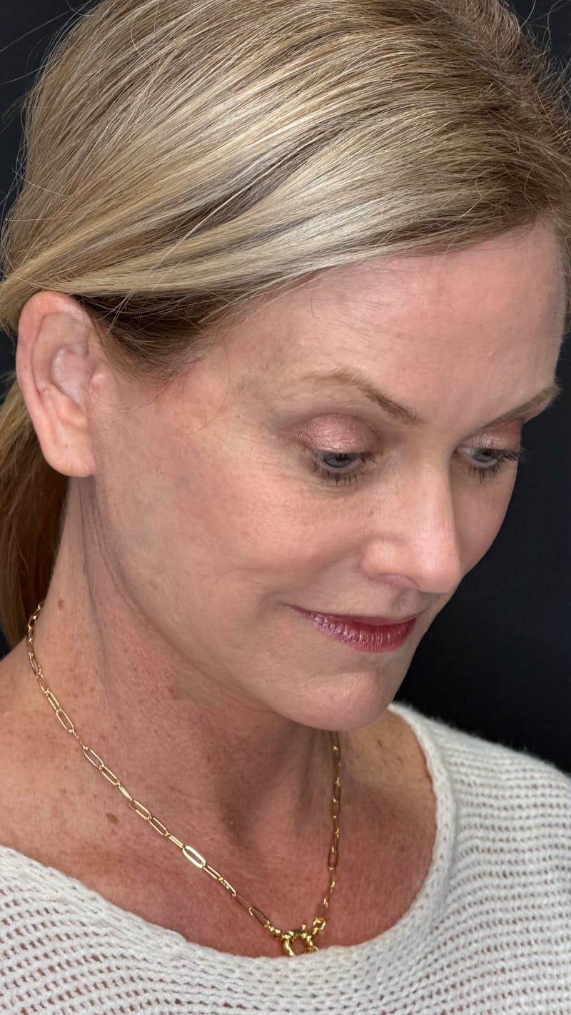 Deep Plane Facelift 50s Before & After Gallery - Patient 334108 - Image 12