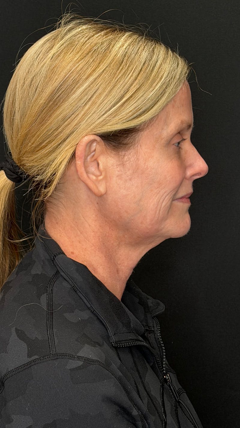 Deep Plane Facelift 50s Before & After Gallery - Patient 334108 - Image 7