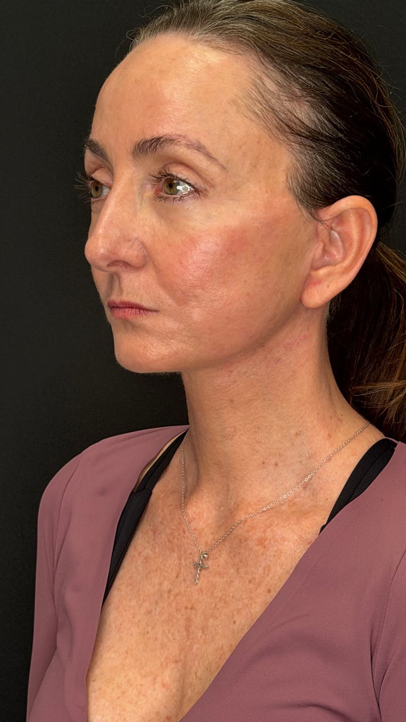 ContourLift Before & After Gallery - Patient 115776 - Image 8