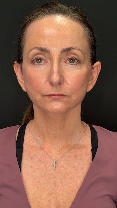 ContourLift Before & After Gallery - Patient 115776 - Image 2