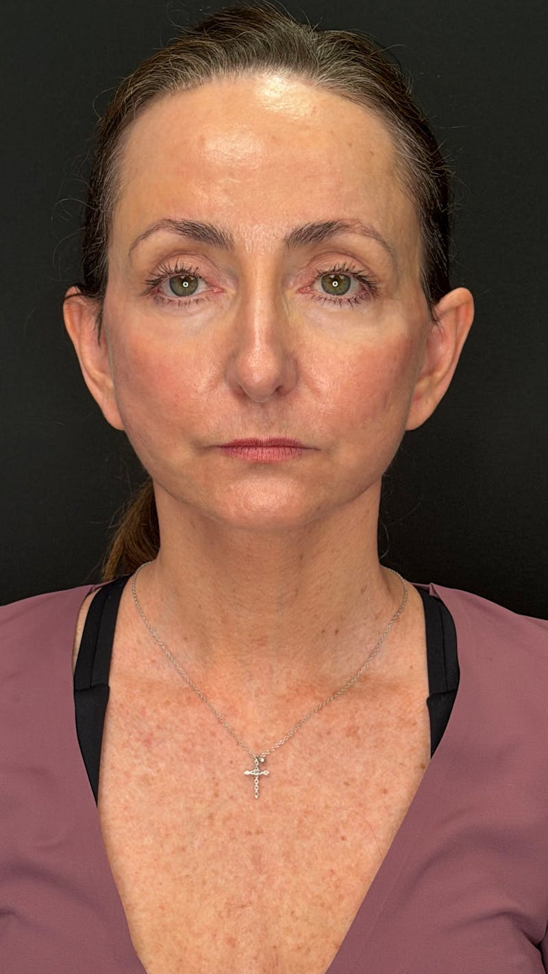 ContourLift Before & After Gallery - Patient 115776 - Image 2