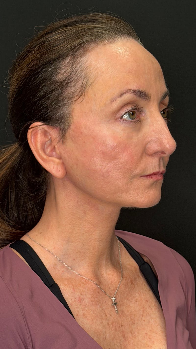 ContourLift Before & After Gallery - Patient 115776 - Image 4