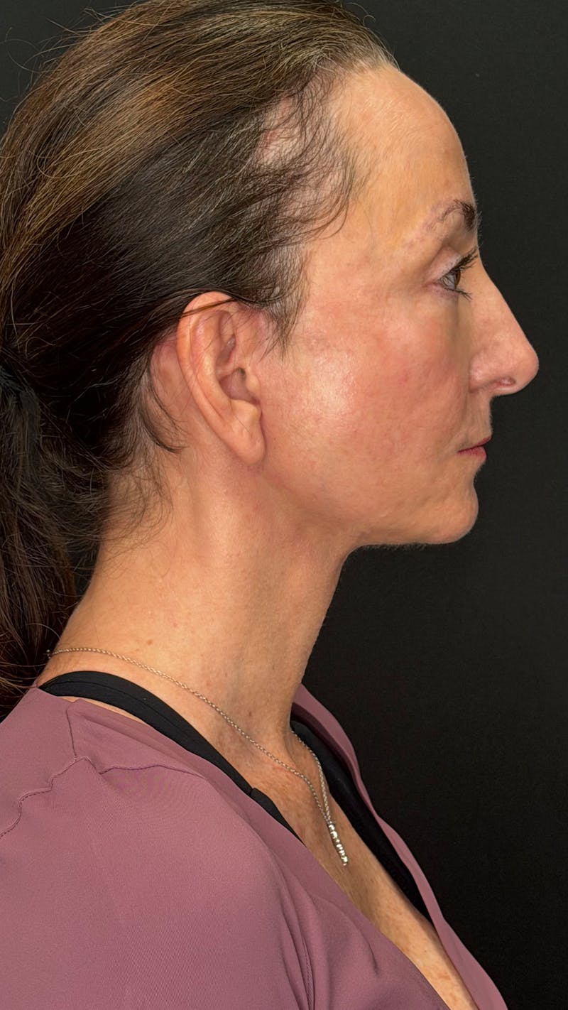ContourLift Before & After Gallery - Patient 115776 - Image 6