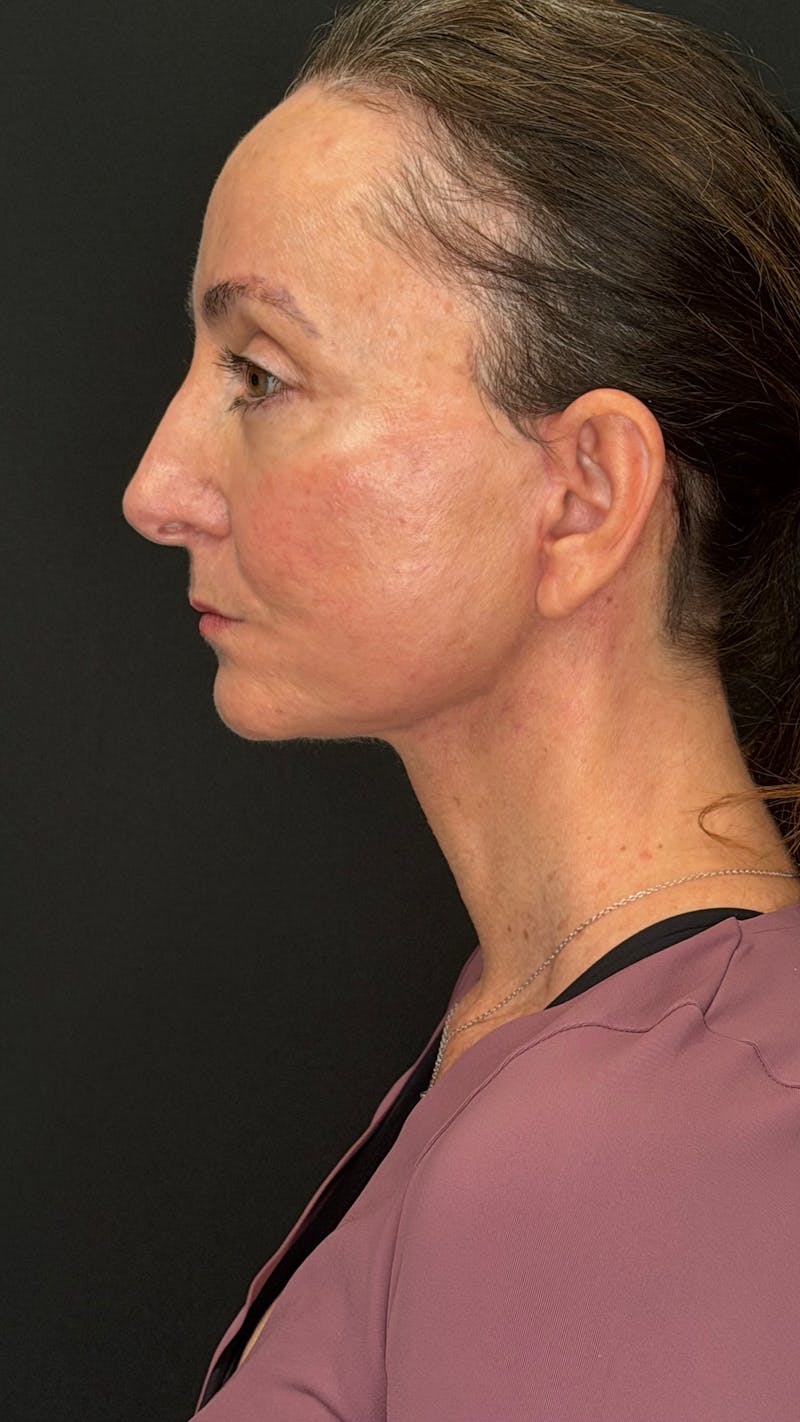ContourLift Before & After Gallery - Patient 115776 - Image 10