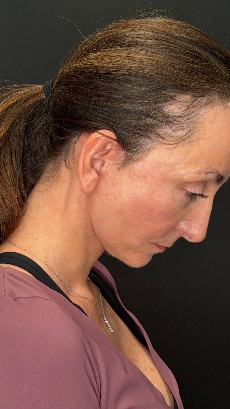 ContourLift Before & After Gallery - Patient 115776 - Image 12