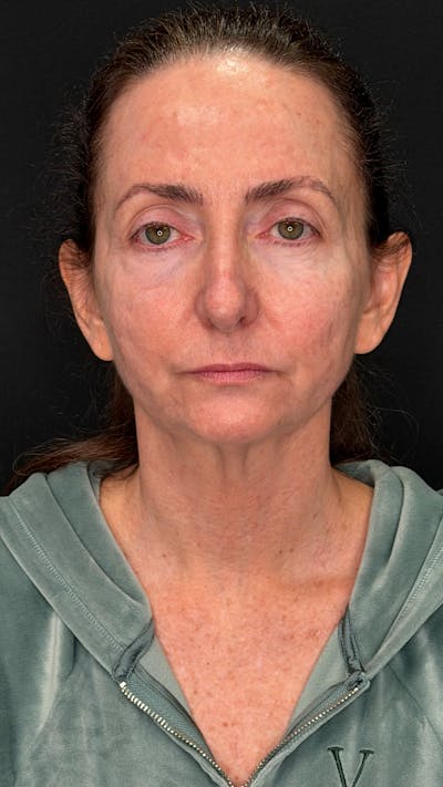 ContourLift Before & After Gallery - Patient 115776 - Image 1