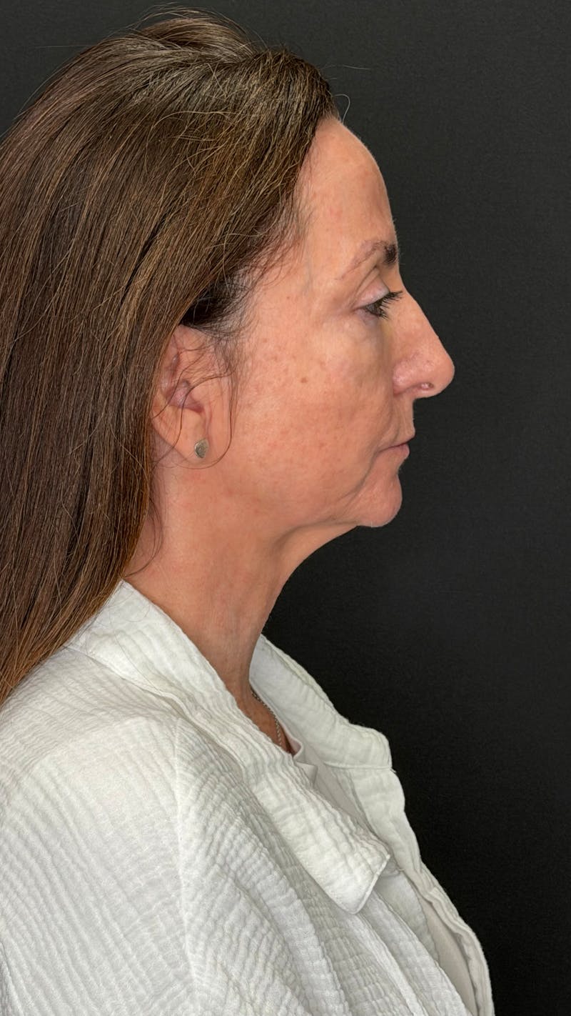 ContourLift Before & After Gallery - Patient 115776 - Image 5