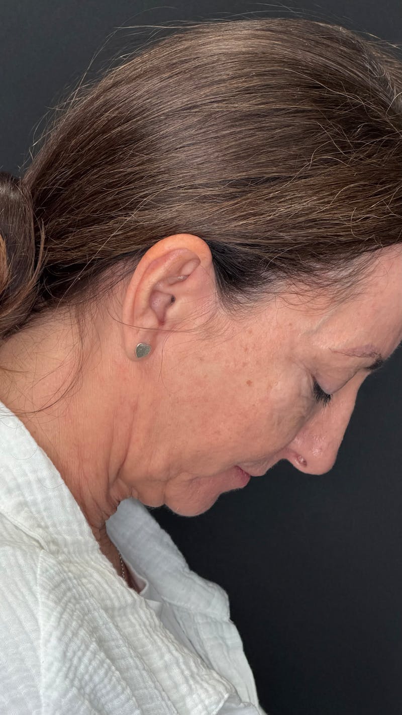 ContourLift Before & After Gallery - Patient 115776 - Image 11