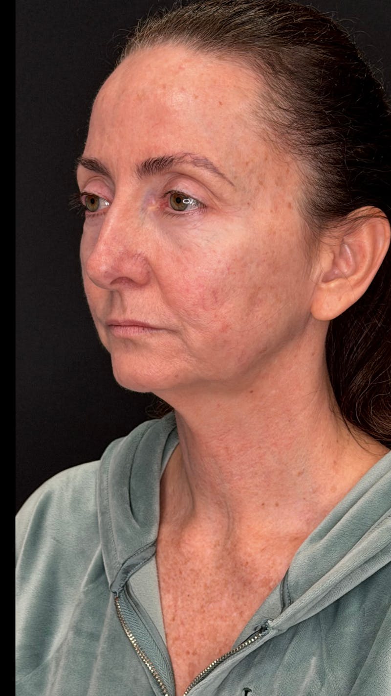 ContourLift Before & After Gallery - Patient 115776 - Image 7