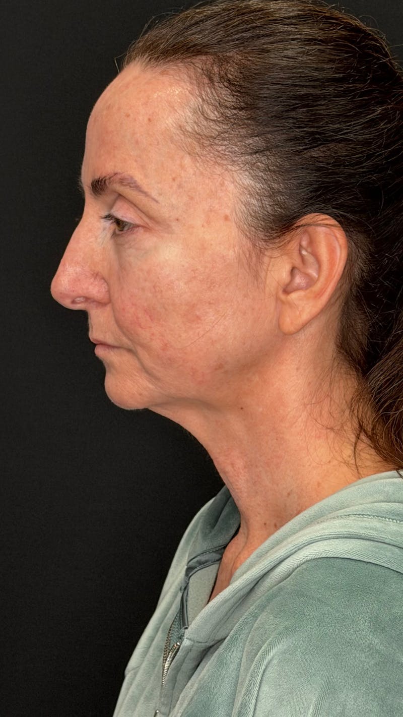 ContourLift Before & After Gallery - Patient 115776 - Image 9