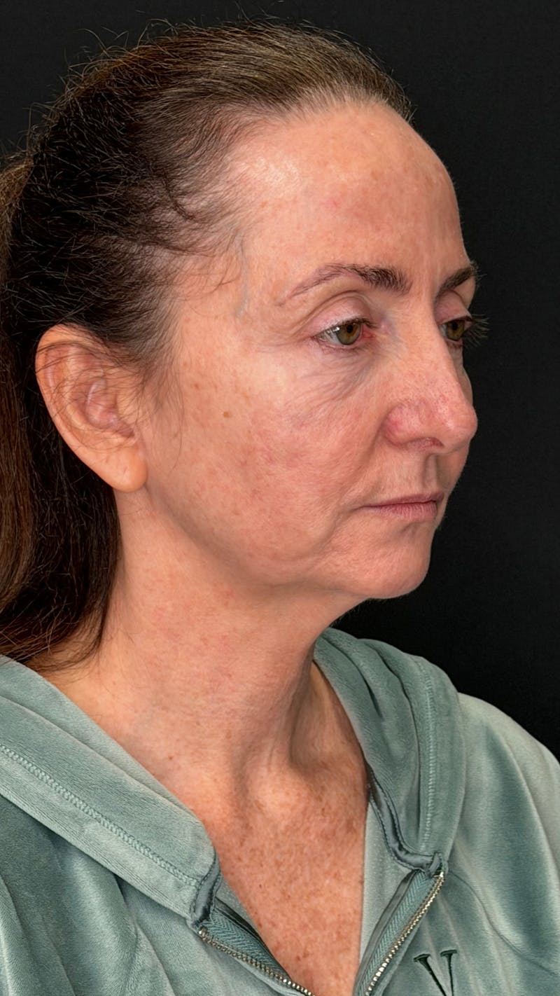 ContourLift Before & After Gallery - Patient 115776 - Image 3