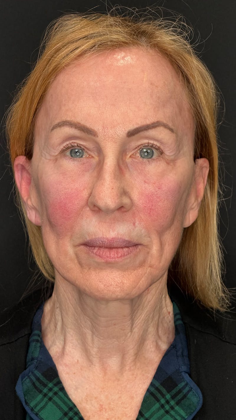 Deep Plane Facelift 70s Before & After Gallery - Patient 157172 - Image 1
