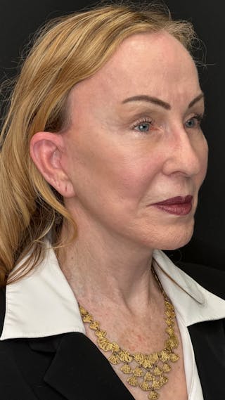 Deep Plane Facelift 70s Before & After Gallery - Patient 157172 - Image 4