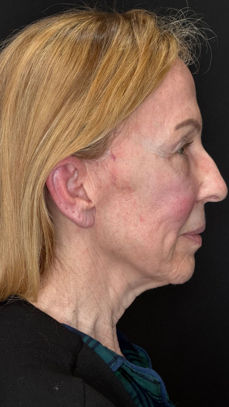 Deep Plane Facelift 70s Before & After Gallery - Patient 157172 - Image 5
