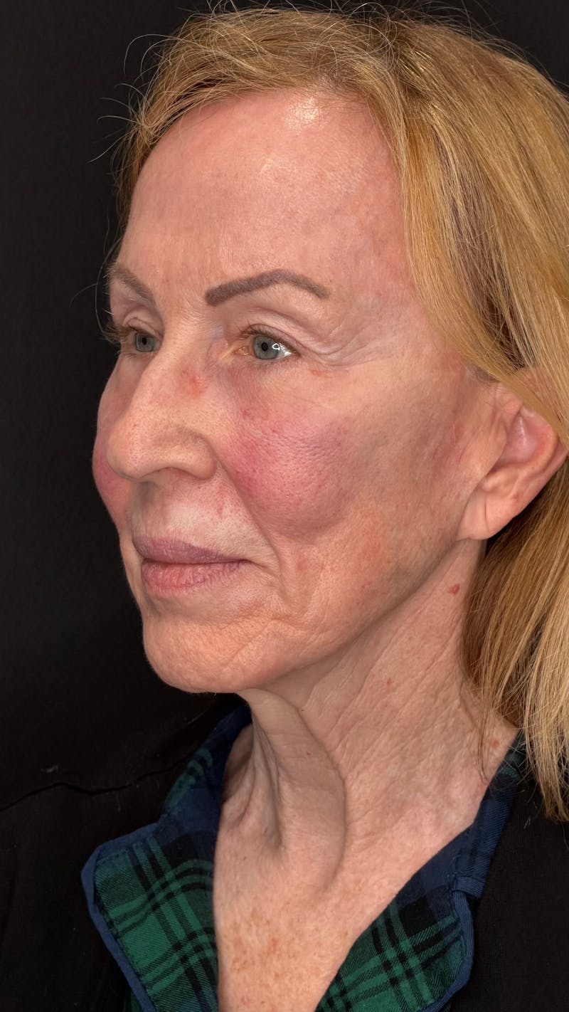 Deep Plane Facelift 70s Before & After Gallery - Patient 157172 - Image 7