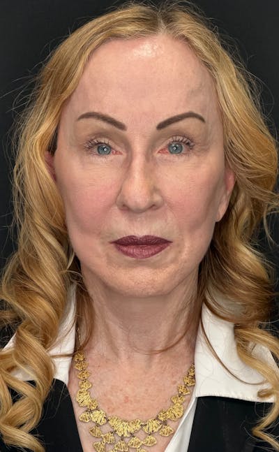 Deep Plane Facelift 70s Before & After Gallery - Patient 157172 - Image 2