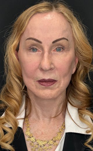 Deep Plane Facelift 70s Before & After Gallery - Patient 157172 - Image 2