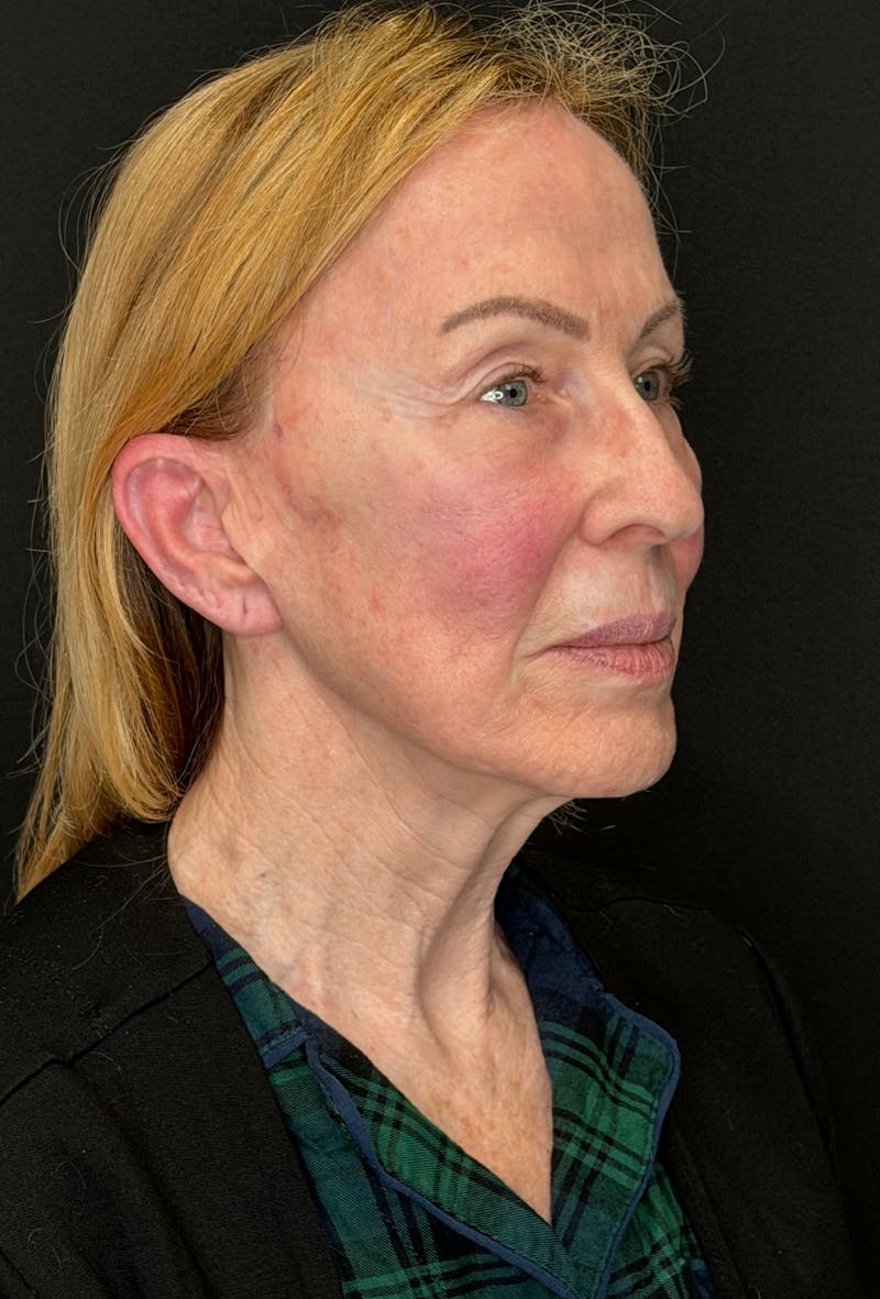 Brow Lift Before & After Gallery - Patient 254090 - Image 3