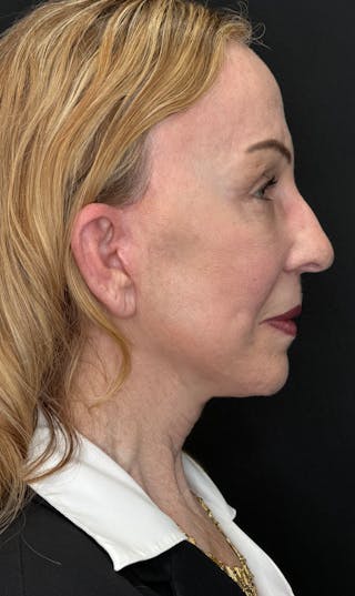 Brow Lift Before & After Gallery - Patient 254090 - Image 6
