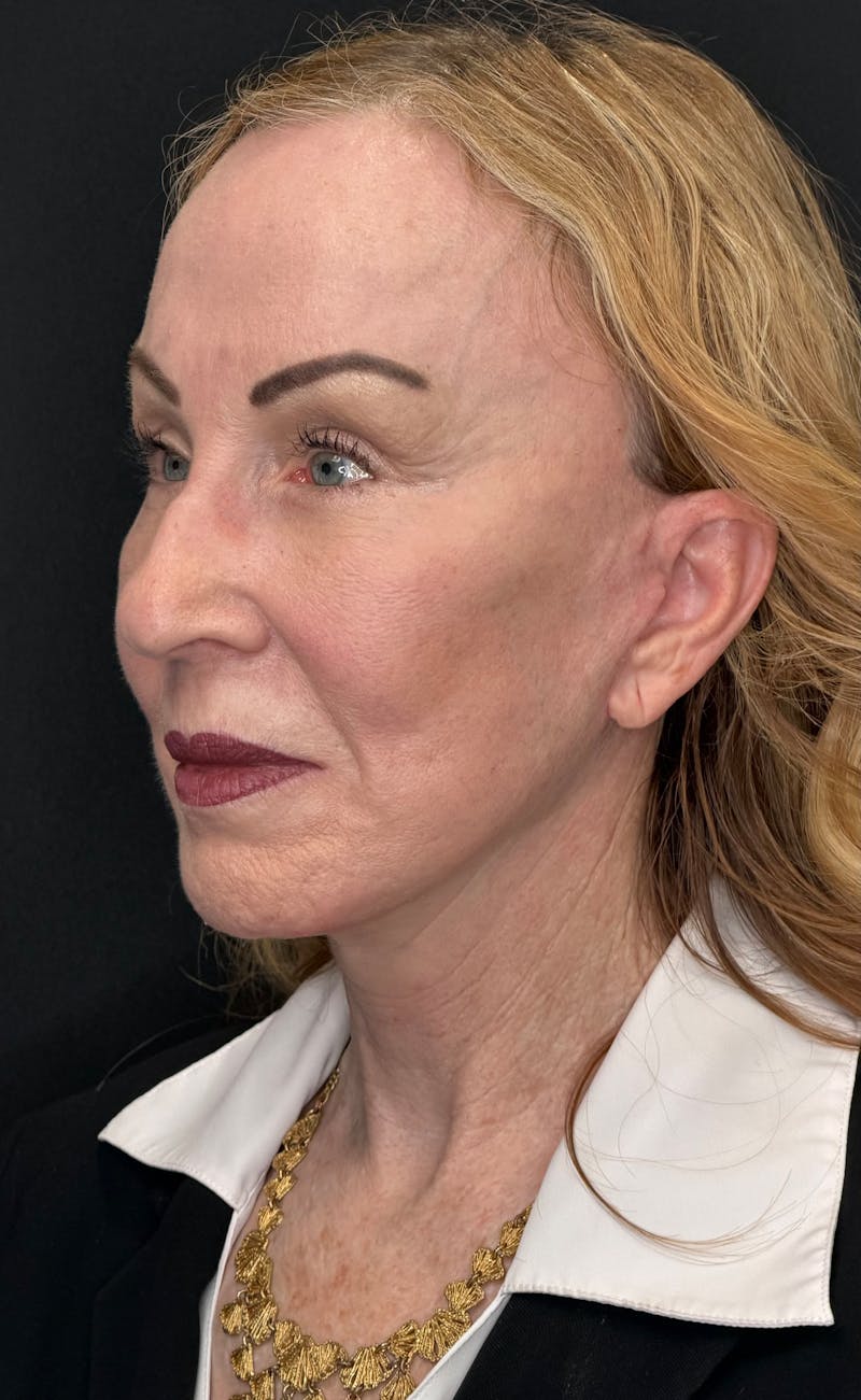 Brow Lift Before & After Gallery - Patient 254090 - Image 8