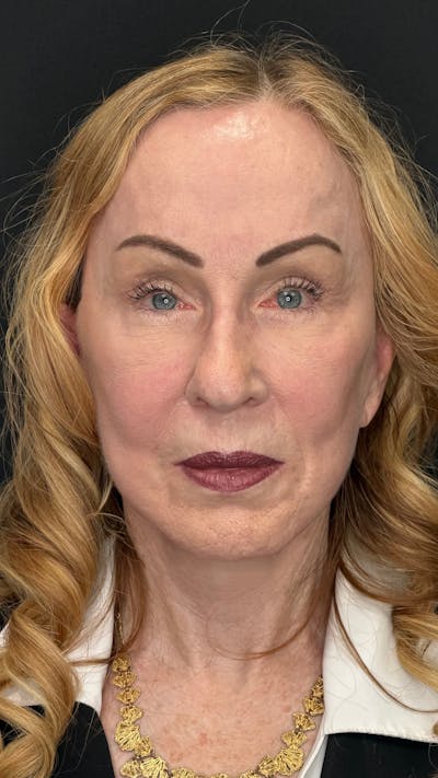 Upper Eye Rejuvenation Before & After Gallery - Patient 360545 - Image 2