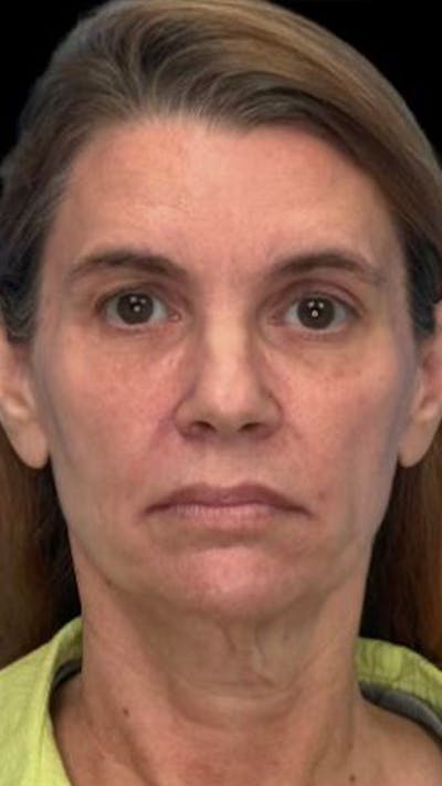 Deep Plane Facelift 50s Before & After Gallery - Patient 143303 - Image 1