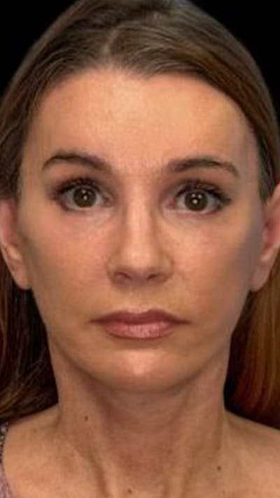 Deep Plane Facelift 50s Before & After Gallery - Patient 143303 - Image 2