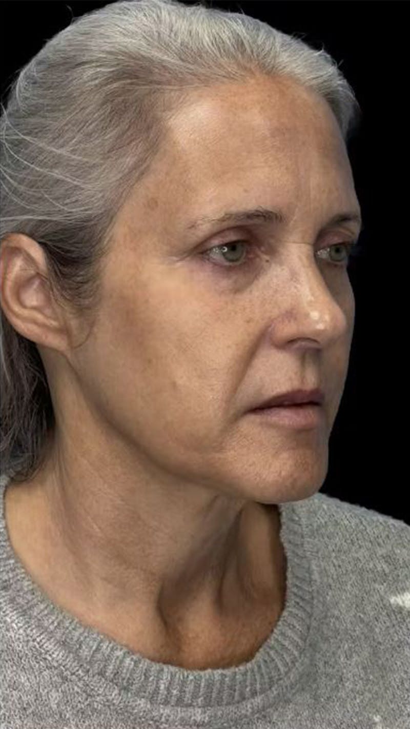 Deep Plane Facelift 50s Before & After Gallery - Patient 295725 - Image 1
