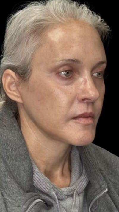 Deep Plane Facelift 50s Before & After Gallery - Patient 295725 - Image 2