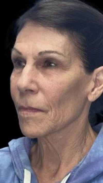 Deep Plane Facelift 70s Before & After Gallery - Patient 104840 - Image 1