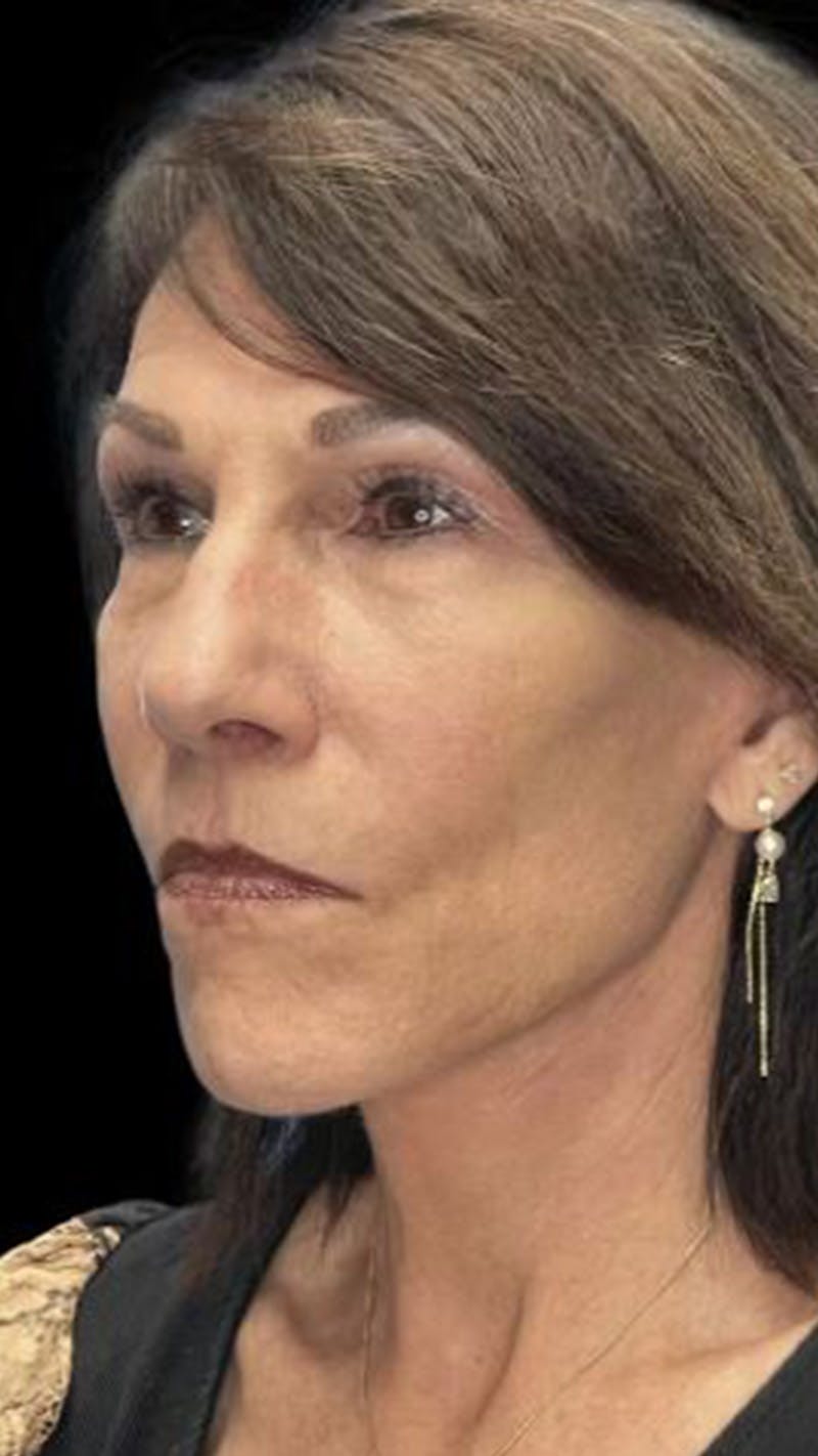 ContourLift Before & After Gallery - Patient 366984 - Image 2