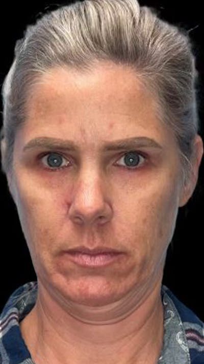 Deep Plane Facelift 40s Before & After Gallery - Patient 423590 - Image 1