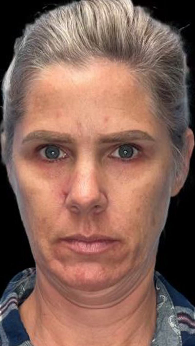ContourLift Before & After Gallery - Patient 340829 - Image 1