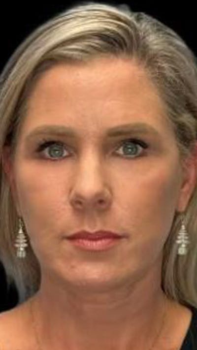 Deep Plane Facelift 40s Before & After Gallery - Patient 423590 - Image 2