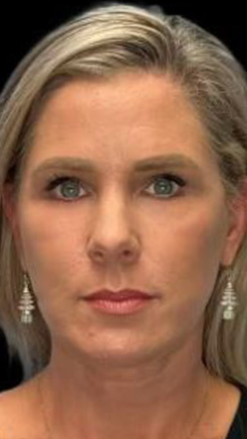 ContourLift Before & After Gallery - Patient 340829 - Image 2