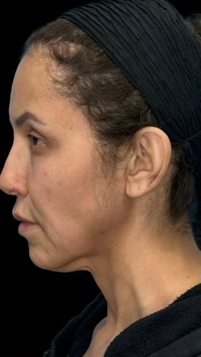 Deep Plane Facelift 50s Before & After Gallery - Patient 351194 - Image 1