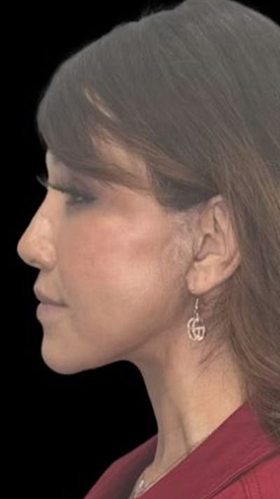 Deep Plane Facelift 50s Before & After Gallery - Patient 351194 - Image 2