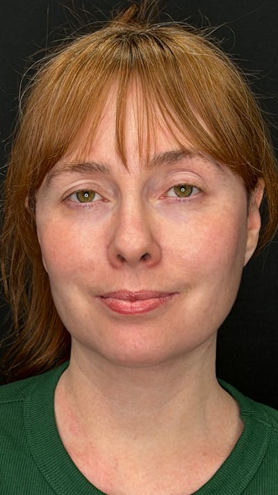 Deep Plane Facelift 40s Before & After Gallery - Patient 423590 - Image 2
