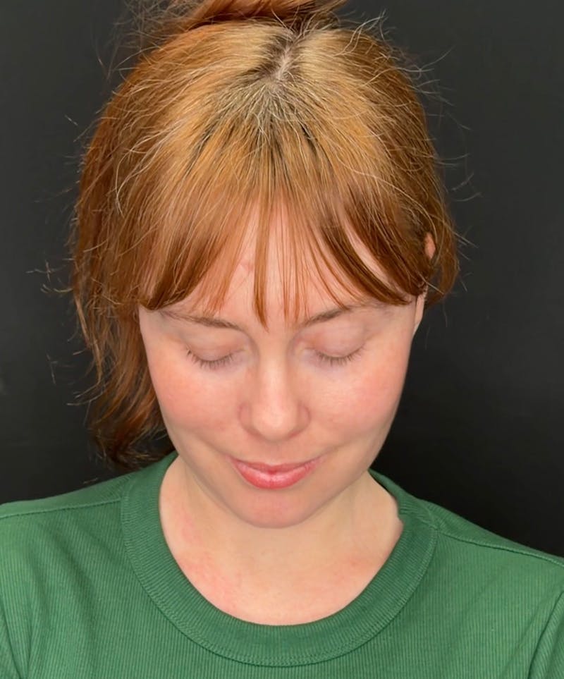Deep Plane Facelift 40s Before & After Gallery - Patient 423590 - Image 4