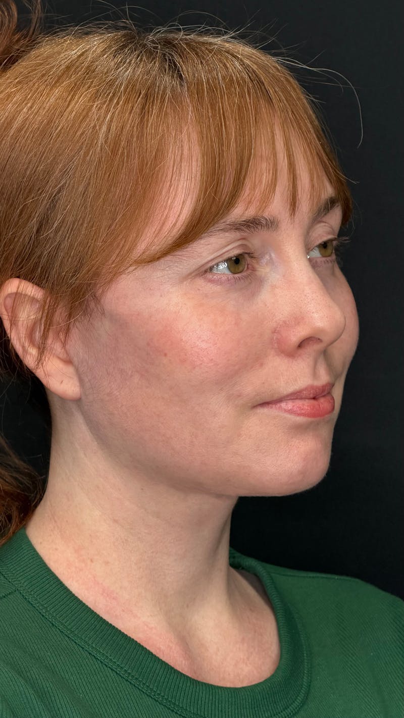 Deep Plane Facelift 40s Before & After Gallery - Patient 423590 - Image 6