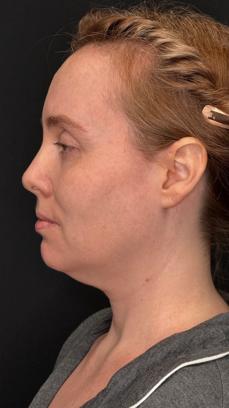 Deep Plane Facelift 40s Before & After Gallery - Patient 423590 - Image 11