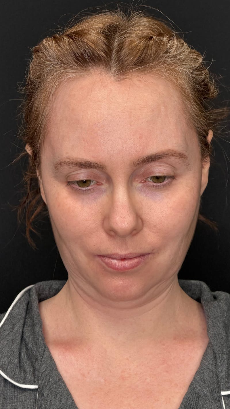 Deep Plane Facelift 40s Before & After Gallery - Patient 423590 - Image 3