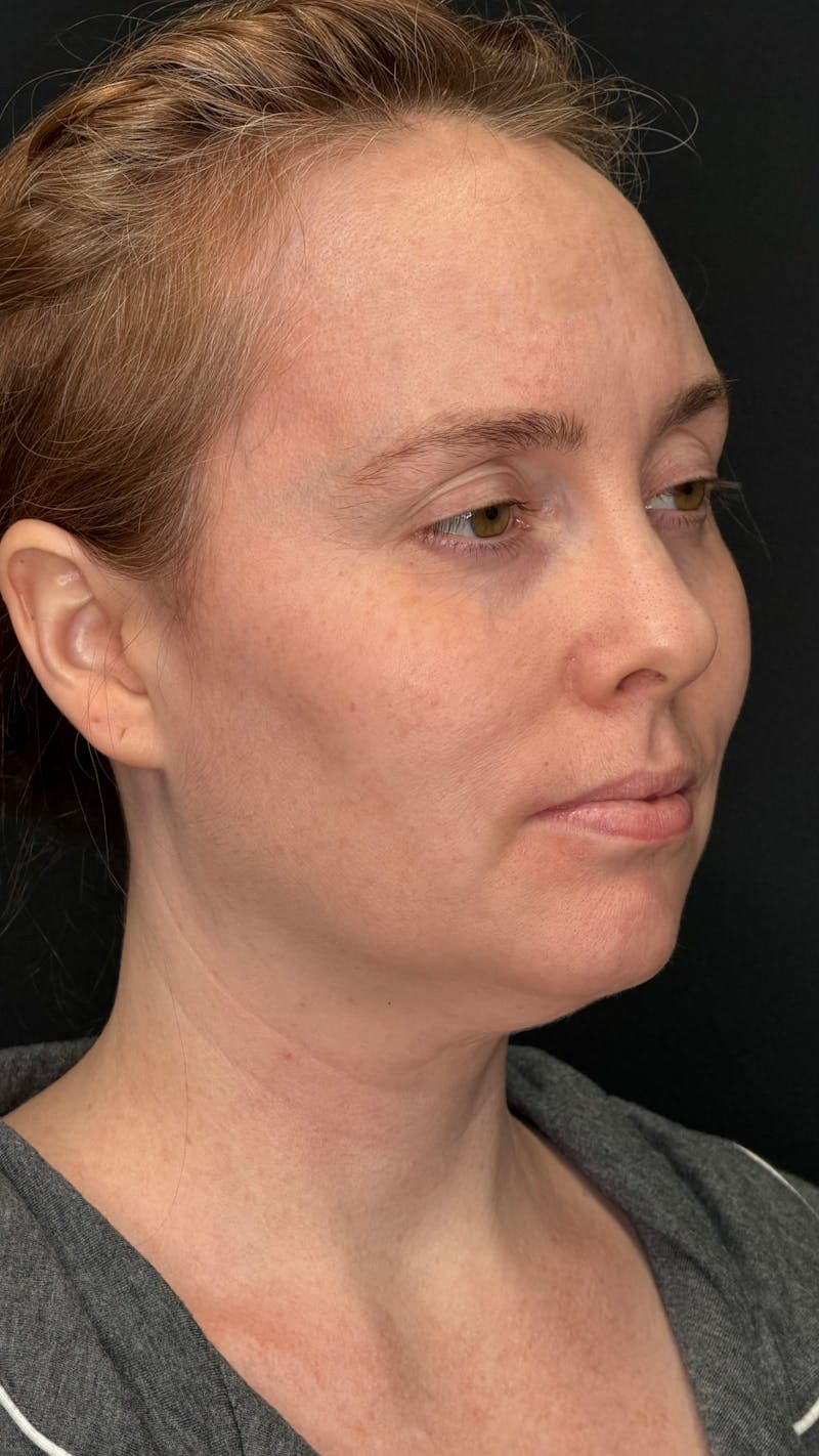 Deep Plane Facelift 40s Before & After Gallery - Patient 423590 - Image 5