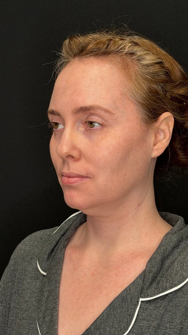 Deep Plane Facelift 40s Before & After Gallery - Patient 423590 - Image 9