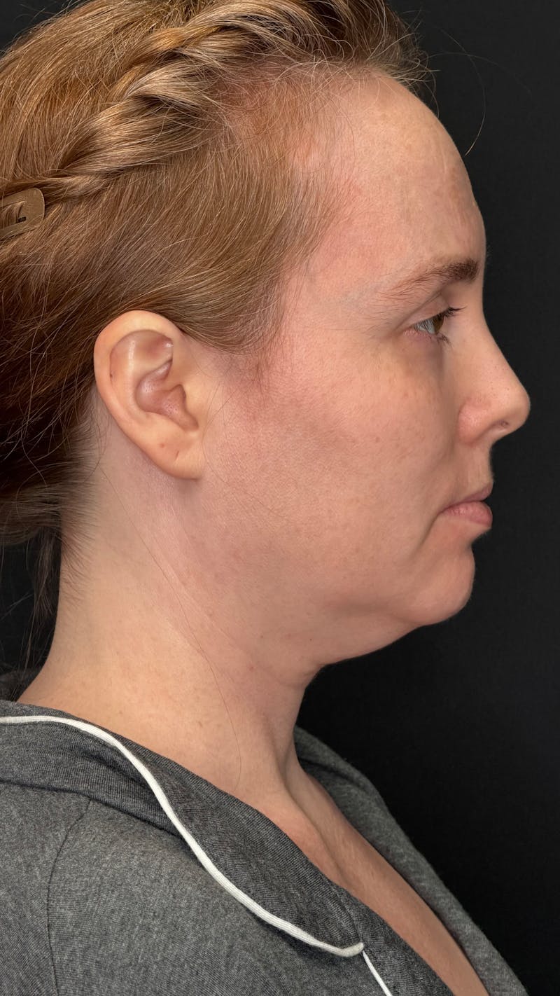 Deep Plane Facelift 40s Before & After Gallery - Patient 423590 - Image 7