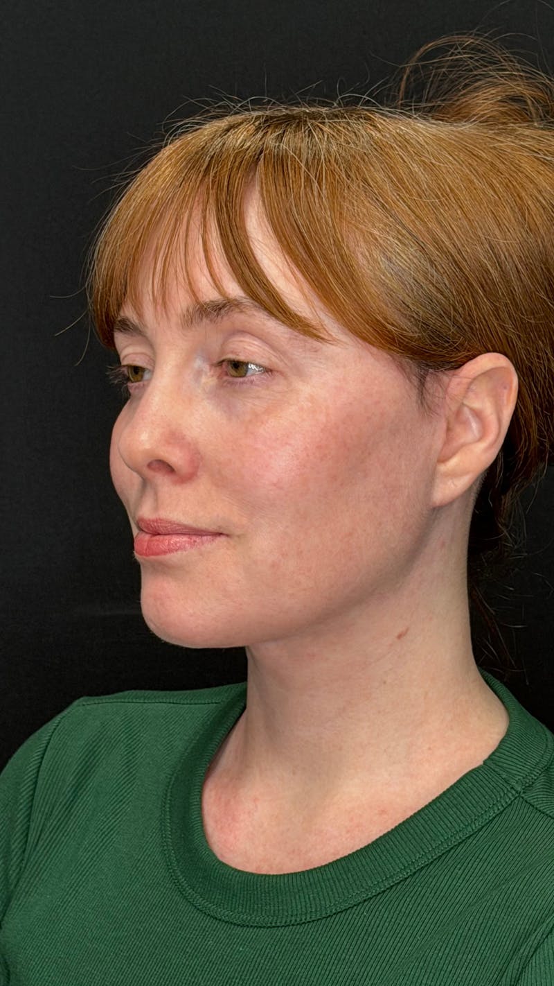 Deep Plane Facelift 40s Before & After Gallery - Patient 423590 - Image 10