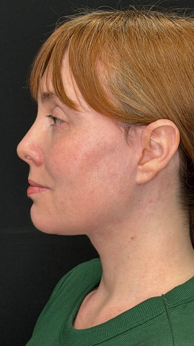 Deep Plane Facelift 40s Before & After Gallery - Patient 423590 - Image 12